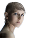 alopecia_totalis