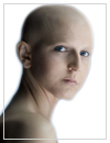 alopecia_universalis